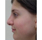 Cosmetic Nose Surgery (Rhinoplasty)